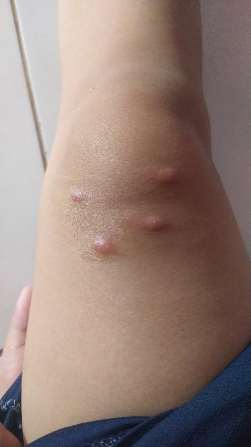 bentol gatal