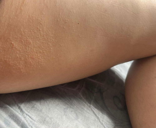 ผื่นคันระหว่างขาหนีบเกิดจากอะไรหรอค่ะ