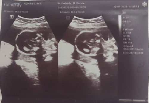 Hamil k 2 bnyak yg d rasa, pas 4 bln katanya Bayi nya ada cairan lebih d kepala. Coba yg prnah shari