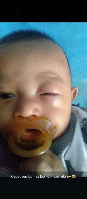 Saran obat sakit mata untuk bayi