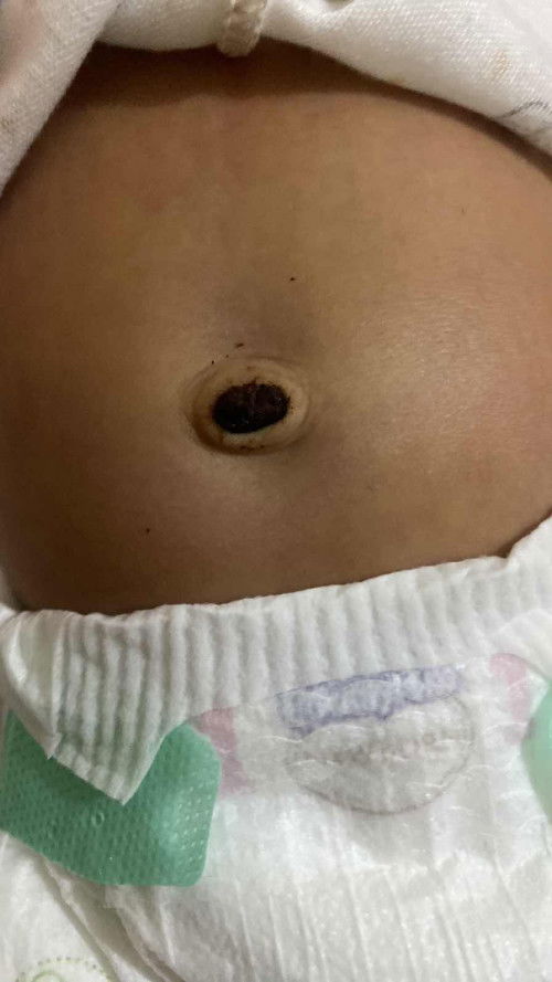 Pusar berdarah setelah puput