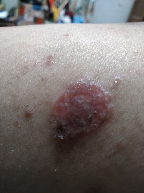 Ada yg gini jga ga Bun sya lg hamil tm2 awalx di gigit nyamuk trus jdi begini susah banget ilang