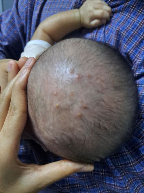 Bintik merah bernanah atas kepala bayi.