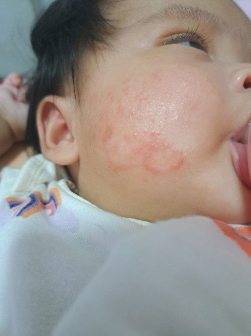 Ano po kaya ito? Prang hindi po baby acne. Nawala na sya tpos bigla bumalik.