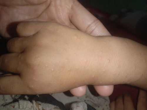 Ruam pada wajah tangan dan kaki bayi