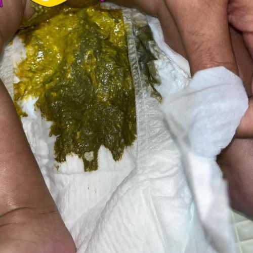 Feses bayi warna abu abu