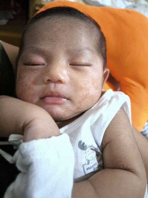 Matagal po ba talaga magpantay at magbalat yung ibang part sa mukha ni baby.