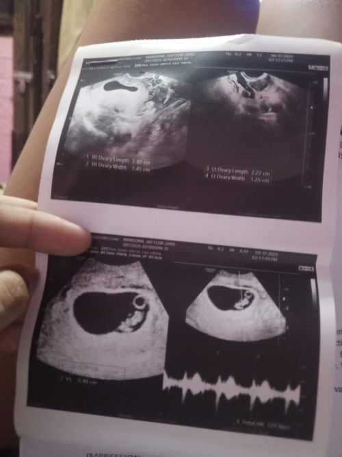 Pwde mag Tanong saan naka posistion si baby right or left 
Pag left poba lalaki pag right poba babae