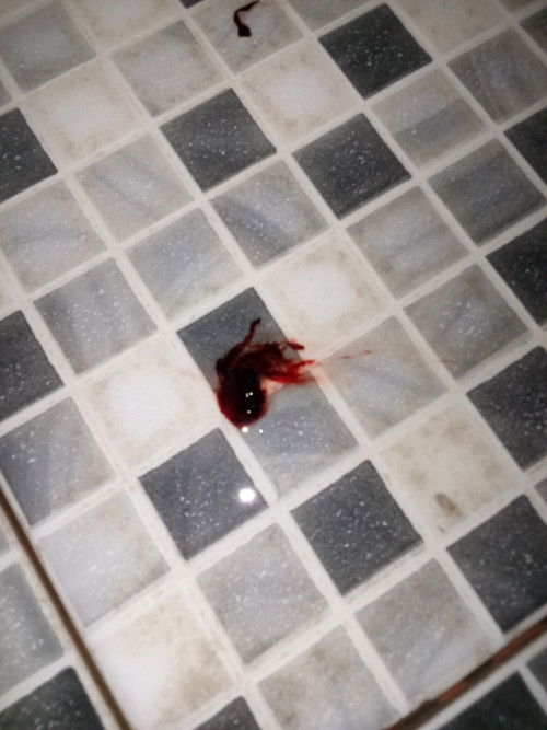 Hamil 7 minggu sempat keluar gumpalan darah