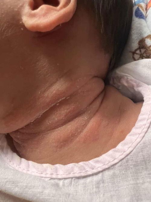 ลูก1 เดือนเป็นผื่นลาม ทั่วคอ