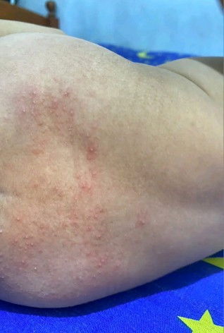 RUAM ? GATAL ALERGI ? BIANG KERINGAT?