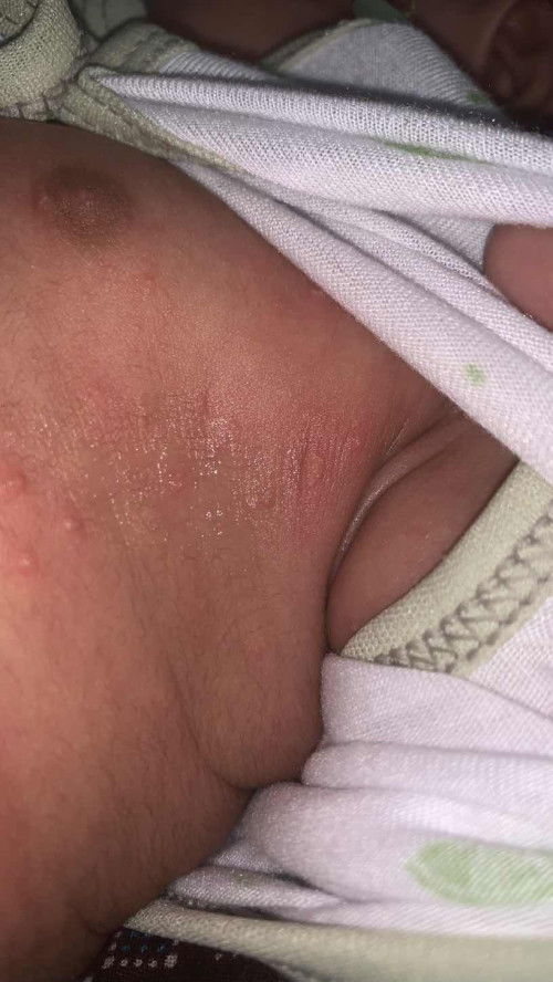 ruam pasir di badan , ada tak yang boleh recommend cream apa yang sesuai ? hmm