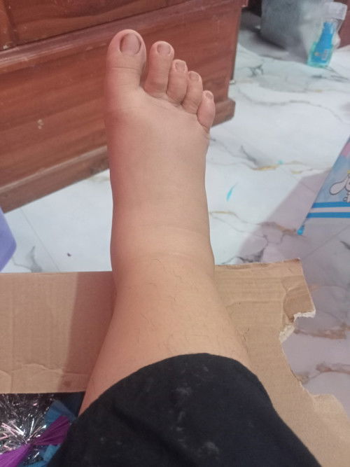 Hallo bunda,q baru melahirkan 4hari lalu,kaki ku bengkak gede bgt,sarannya biar bengkaknya berkurang