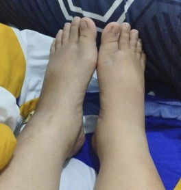 Kaki bengkak