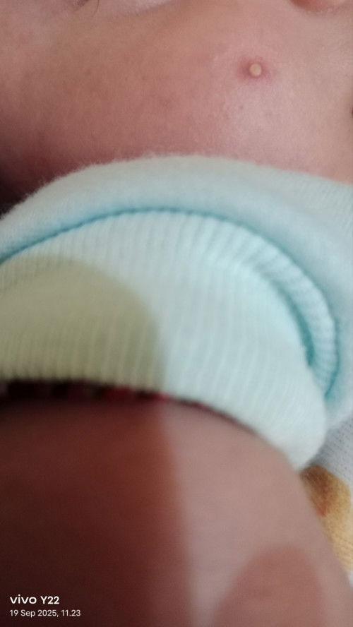Jerawat di wajah bayi