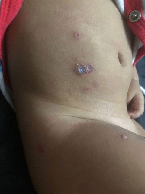 siapa pernah macamni. kulit baby macam melepuh??