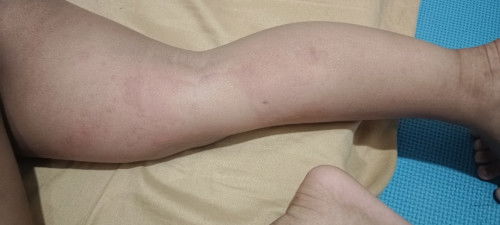 Rashes po na mainit lumalabas everytime may lagnat