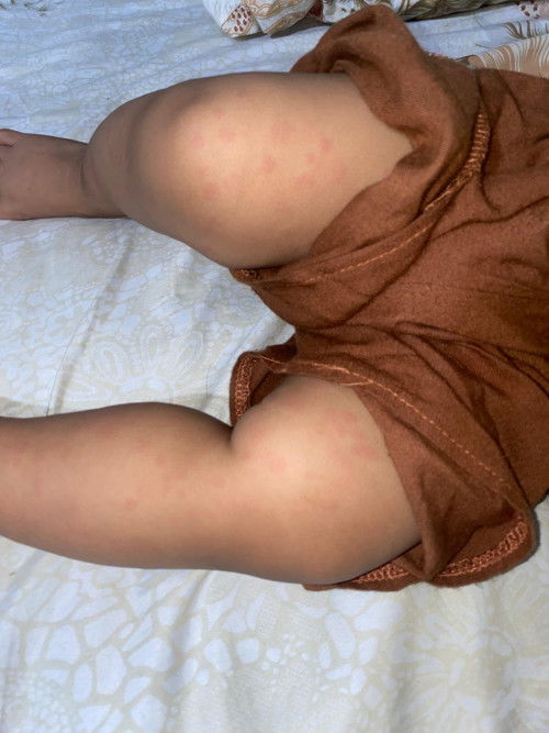 Suntik campak bayi 9 bulan