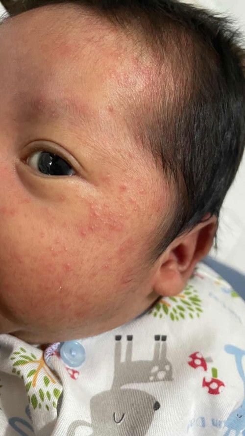 Merintis pd wajah bayi