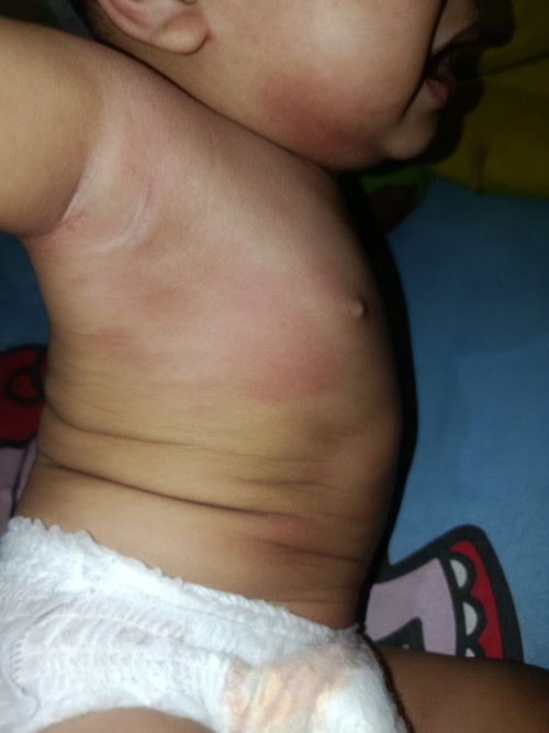 Merah dan bentol seluruh tubuh pada bayi 8 bulan