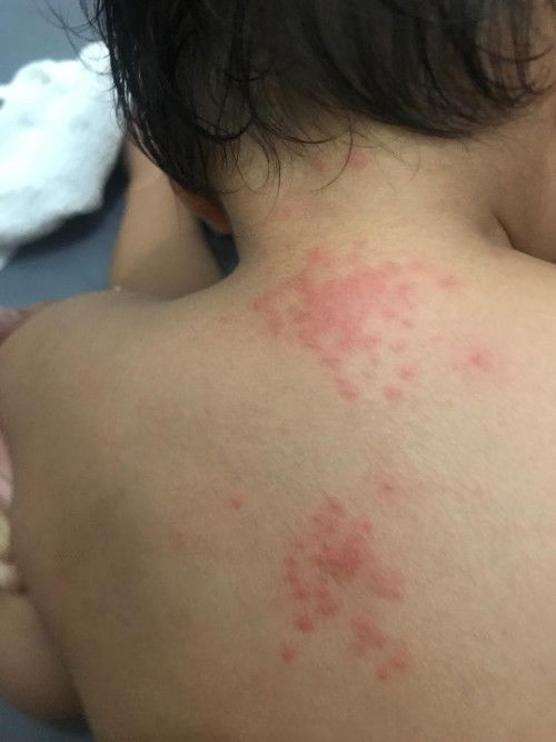 Merah2 pada punggung anak 1th