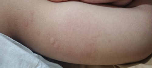 rashes na lumalabas tuwing may lagnat