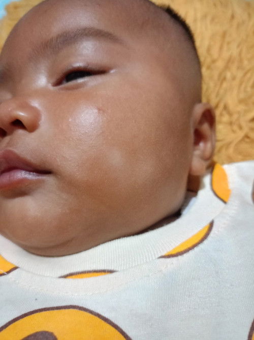 Putih putih di pipi