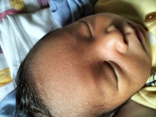 Wajah beruntusan