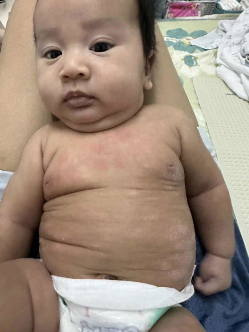 ลูก 2 เดือน มีผื่นขึ้นแบบนี้ ที่หน้าและลำตัว ใช่ขี้หลากน้ำนมไหมค่ะ มียาตัวไหนหรือรักษายังให้หาย เครียดมาก ไม่หายสักที