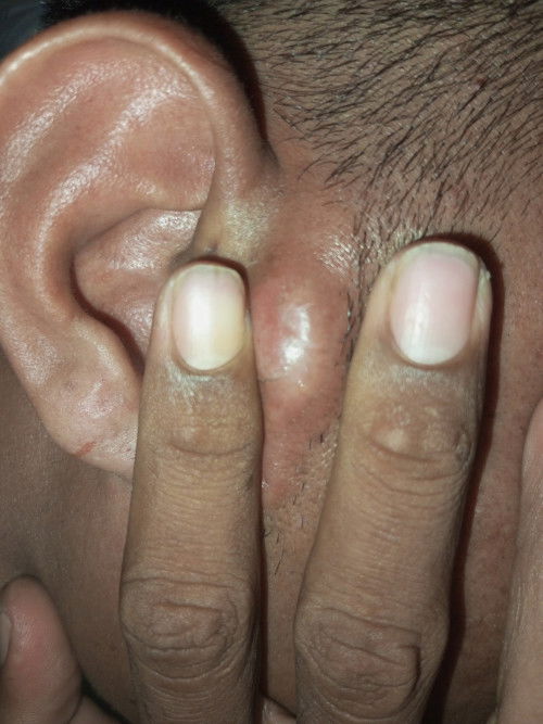 Benjolan di dekat telinga