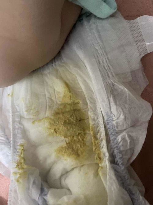 Light yellow poop