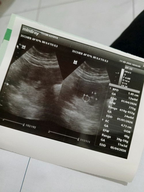 .otw anak ke 2, dengan bb yang udah gemuk dari 82, skrg.85 hamil 10week,semoga tdk naik terlalu bnyk