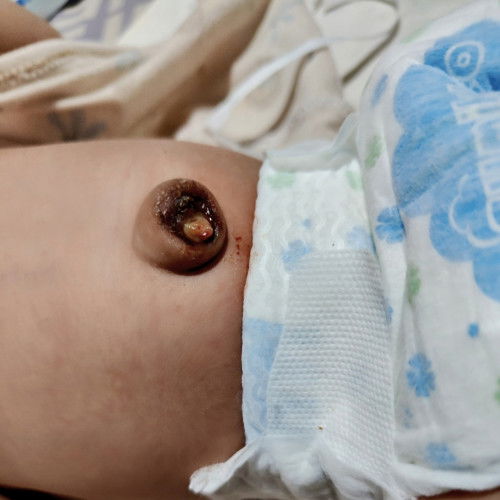 17 days old baby umbilical stump