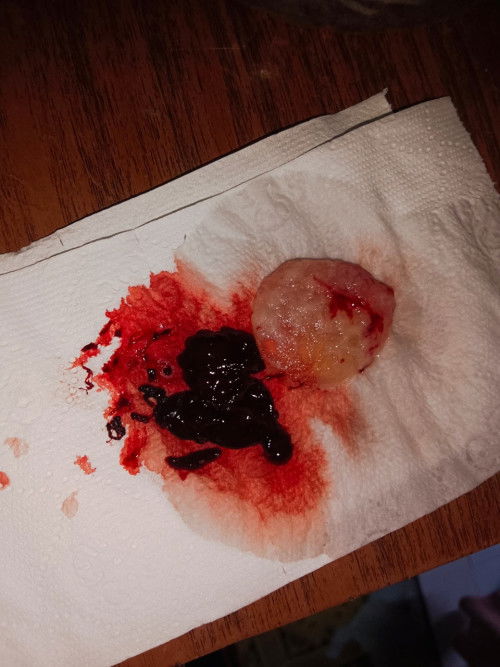 Pregnant dh 8 minggu keluar gumpalan darah cmni, apakah ini tanda gugur ?