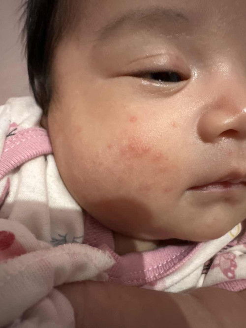 ruam merah di pipi newborn