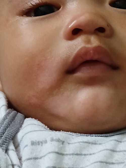 Ruam asi,jadi bercak putih