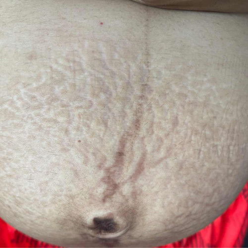 รอยแตกลายหลังคลอด