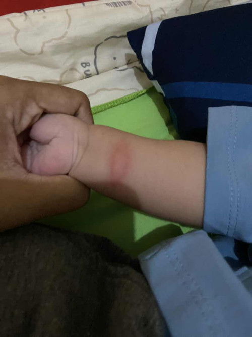 Tangan bentol besar