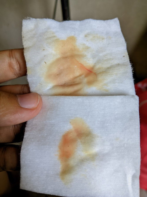 Keluar keputihan bercampur lendir darah