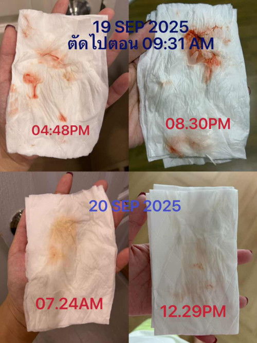 ติ่งเนื้อปากมดลูกตอนท้อง