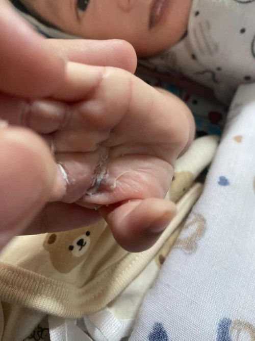 หนังที่มือน้องลอกแบบนี้เป็นอะไรมั้ยคะ น้องคลอดได้28แล้วค่ะ น้องเหมือนจะไม่เจ็บไม่แสบด้วยค่ะเวลาเช็ดมือหรือไปสัมผัส น้องดูปกติมาก