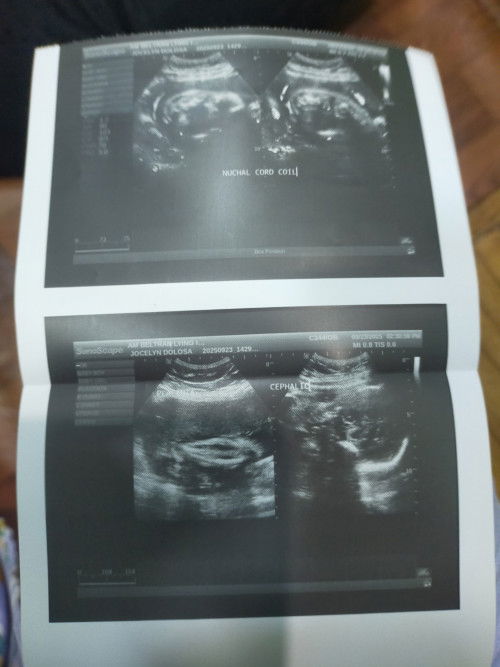 Normal or delikado ba ang nuchal Cord Coil ?