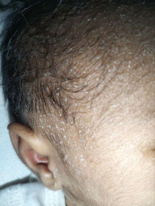 Baby Beruntusan