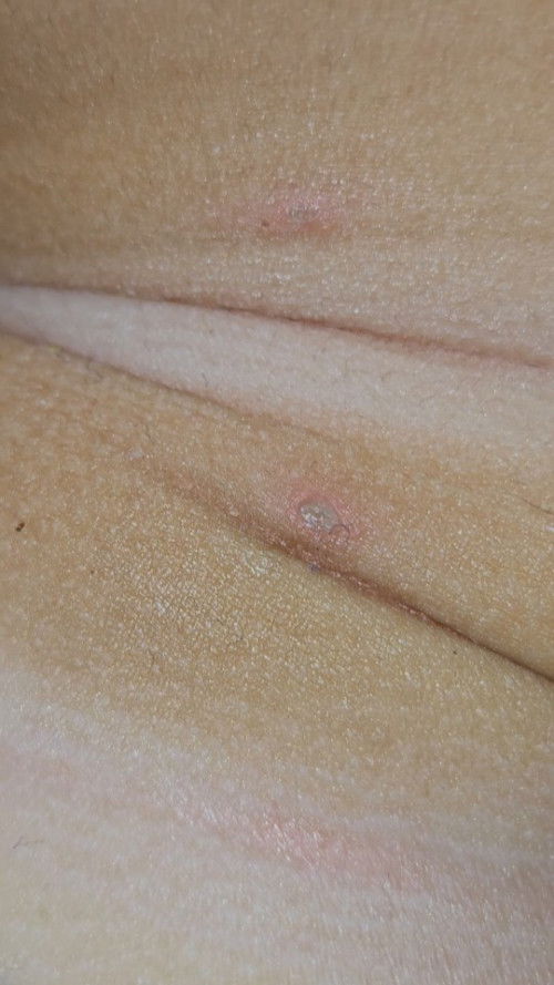 Melenting pada leher bayi