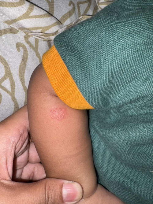 Bintik merah pada anak