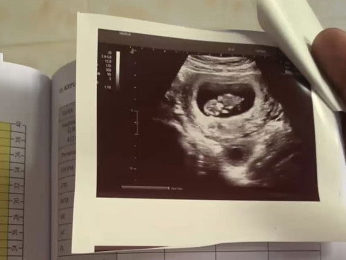 2nd pregnancy (9w) with cyst