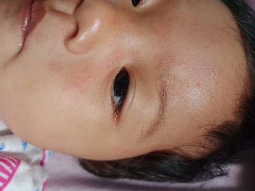 Bruntusan bayi 9 bulan