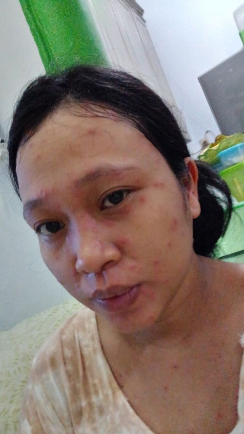 Judul nya lagi kena cacar 😢