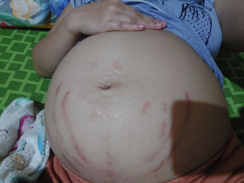 Galit na galit ang stretch mark ko
