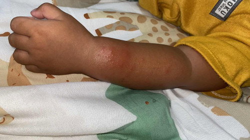 ruam tangan karena makan telur berlebih